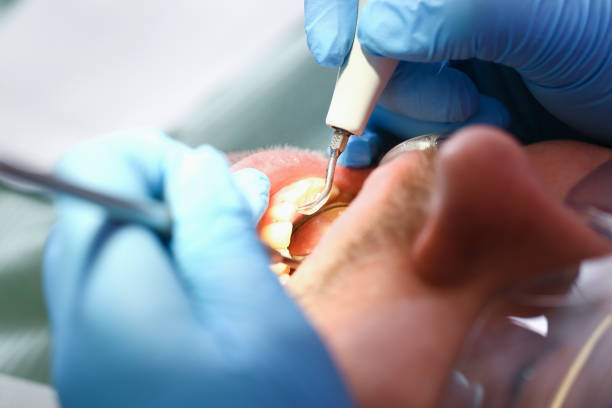 Best Emergency Dental Care for Abscessed Tooth in Miamisburg, OH